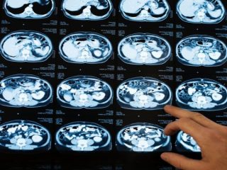 Deteksi Dini Stroke, RS PON Hadirkan Layanan Unggulan Brain Check Up